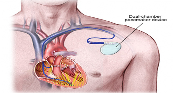 Abnormalities of Heart Rhythm